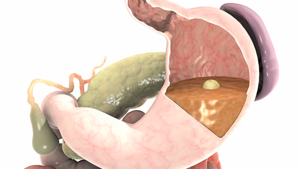 Когда комок пищи попал в желудок, тот начинает сокращаться Что происходит с едой в желудке?