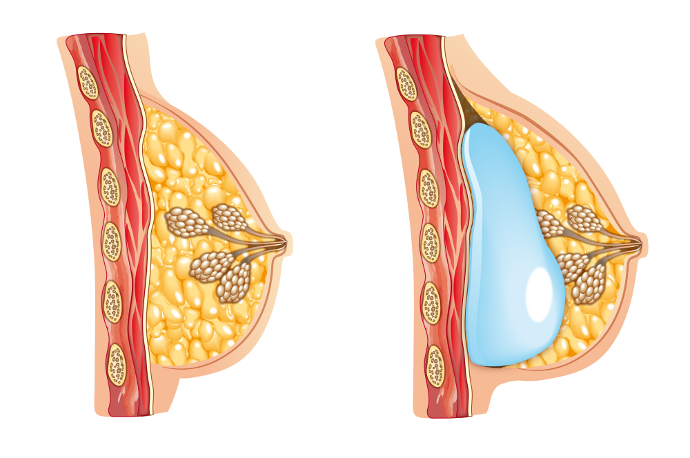 Мастопатия - группа заболеваний молочной железы, общие свойства которых - отсутствие первичного очага воспаления, а также наличие гиперплазии, пролиферации или доброкачественной опухоли. Мастопатия