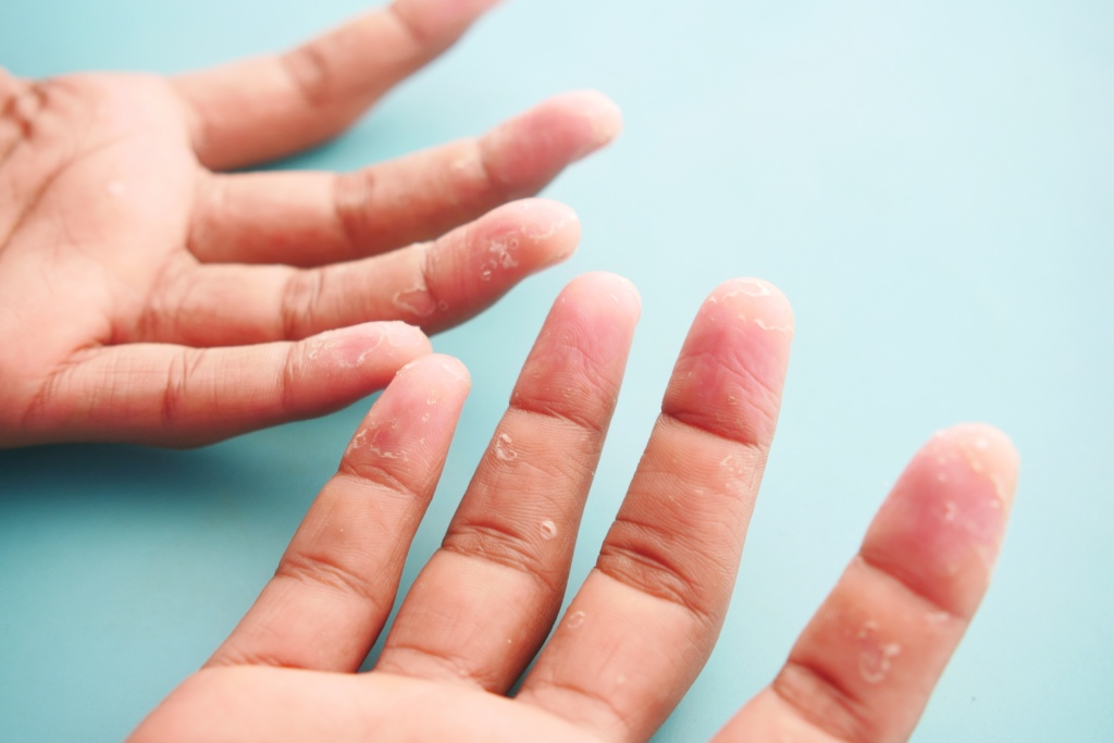 Cухая кожа на пальцах может быть симптомом неправильного функционирования внутренних органов, нарушения работы иммунной системы Cухая кожа на пальцах