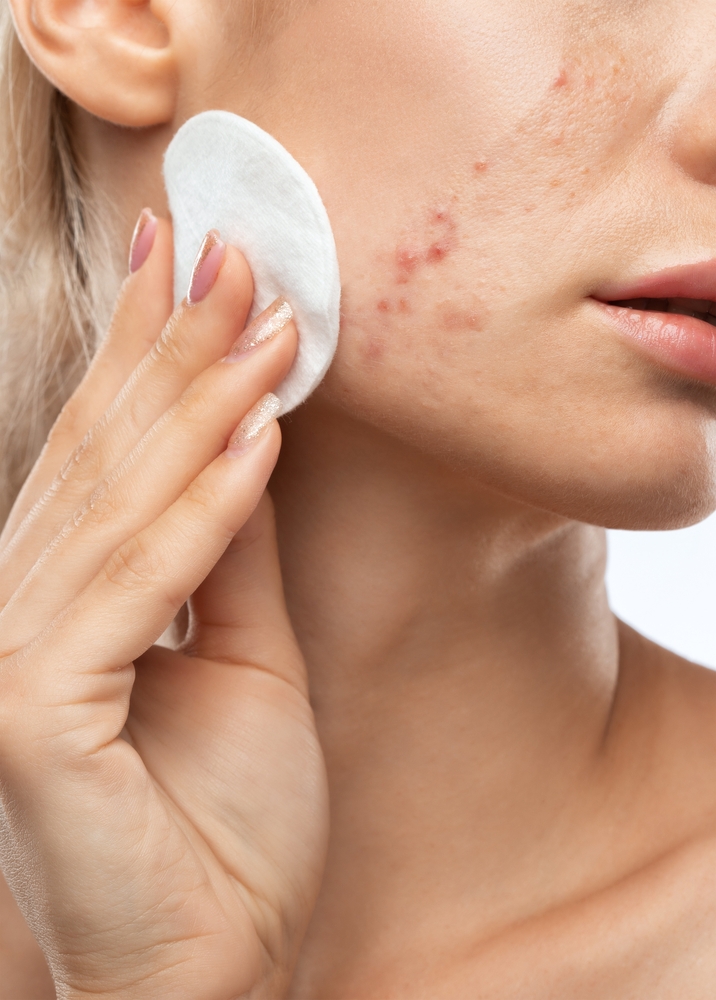 Для лечения акне подходят препараты для наружного применения с высоким содержанием витамина А Как лечат акне