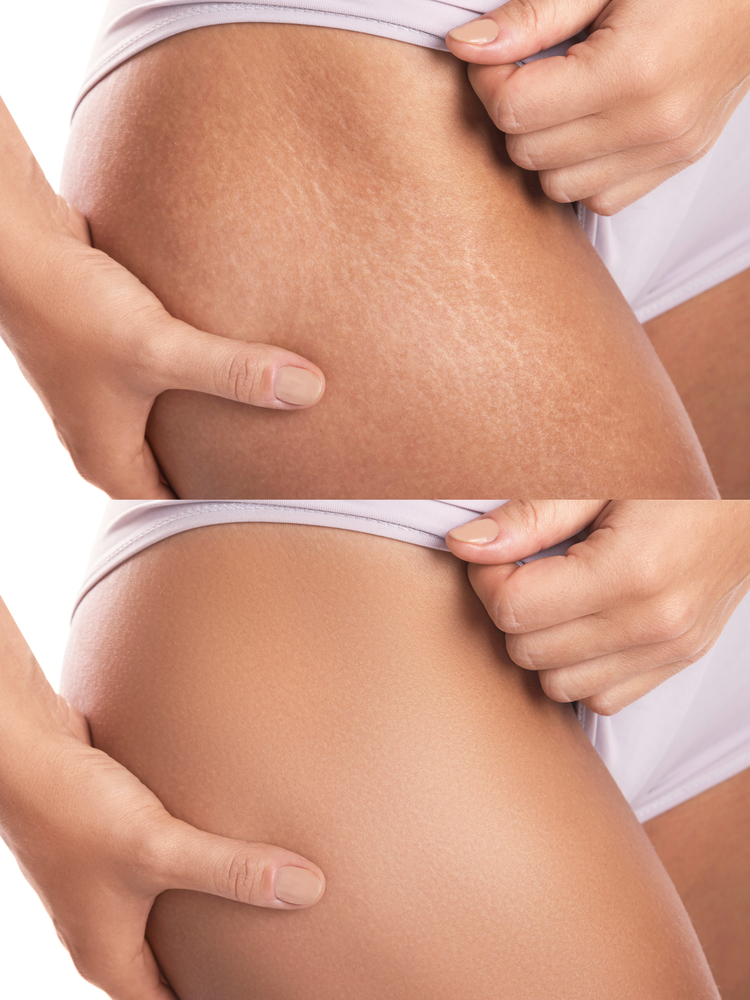 Растяжки могут появляться на теле в любом возрасте Растяжки