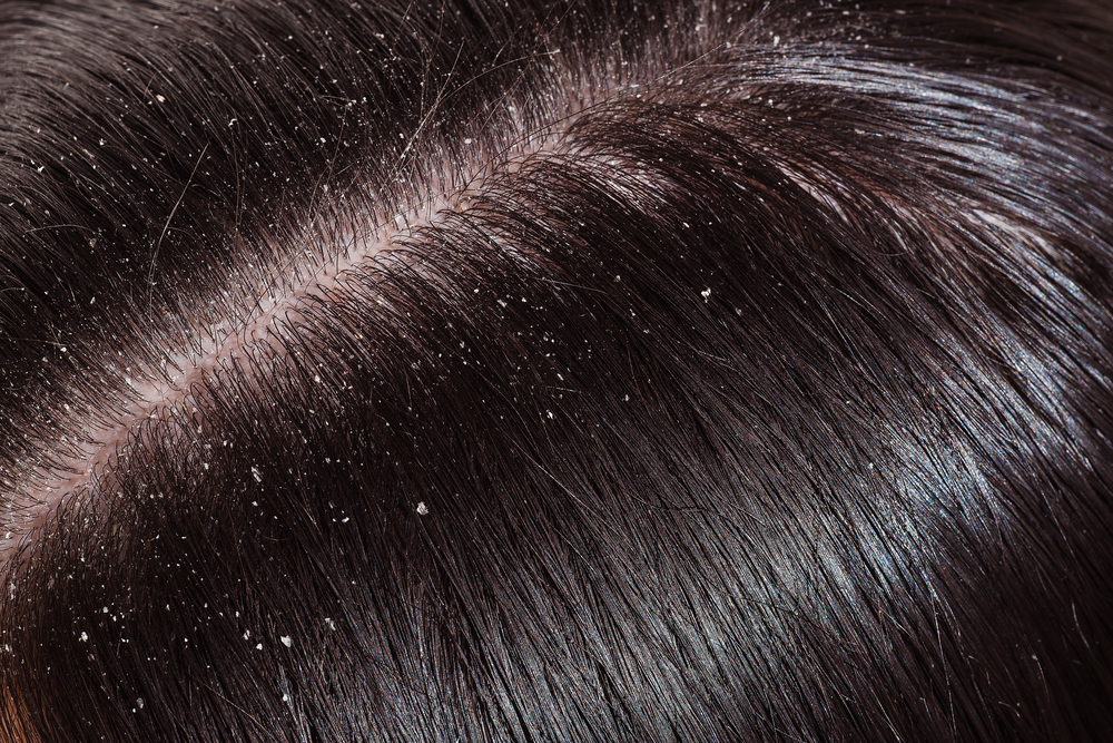 Перхоть - очень распространенное в мире заболевание. Его провоцирует дрожжевой вредоносный грибок Перхоть