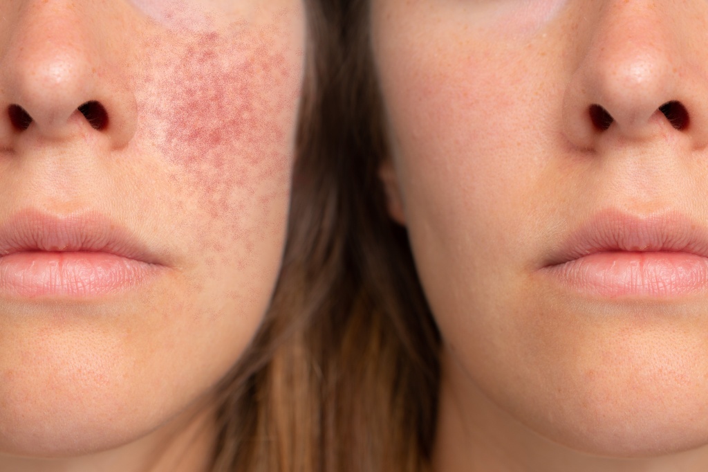 Об укреплении сосудов на лице люди часто задумываются уже тогда, когда на поверхности кожи появляются красные сеточки, называемые куперозом Почему у человека лопаются сосуды на лице?