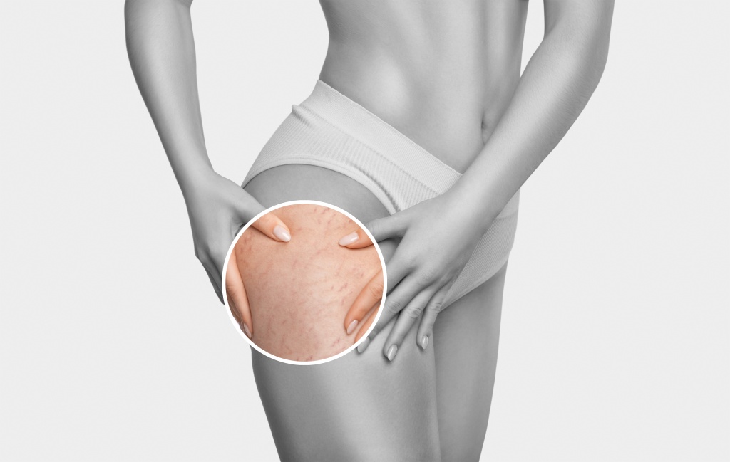 Предпосылок для появления растяжек множество От чего появляются растяжки на бедрах?