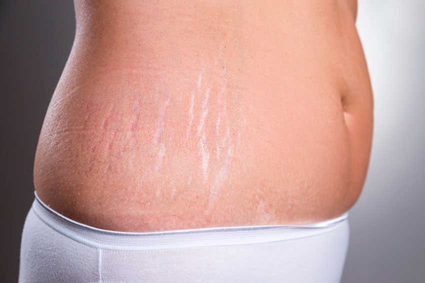Некоторые люди замечают на коже продольные или поперечные полоски различной длины и интенсивности, которые наносят значительный урон самооценке и физической привлекательности Причины появления белых растяжек