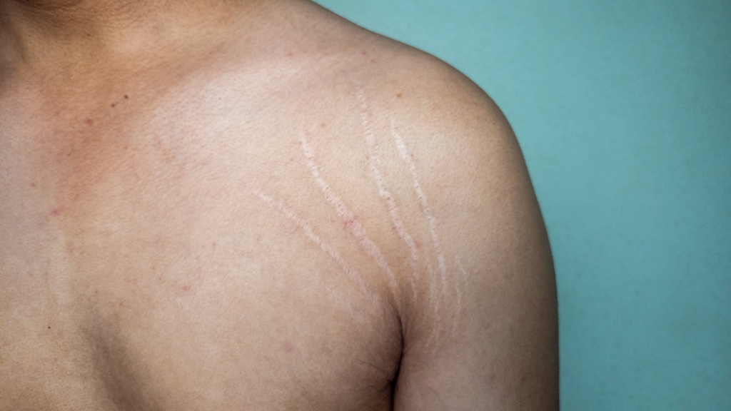 Считается, что от растяжек (стрий) на коже страдают только женщины, но проблема распространена также и среди мужского населения Причины возникновения стрий у мужчин