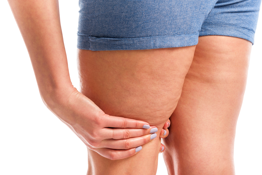 Бедра, ляжки и их внутренняя сторона для многих женщин являются проблемными зонами Бедра, ляжки