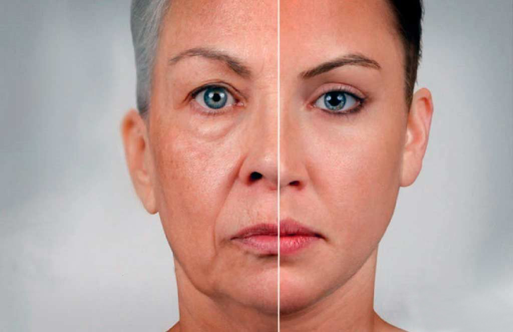 С обвисанием лица и дряблостью тканей со временем сталкиваются многие женщины Причины возникновения гравитационного птоза