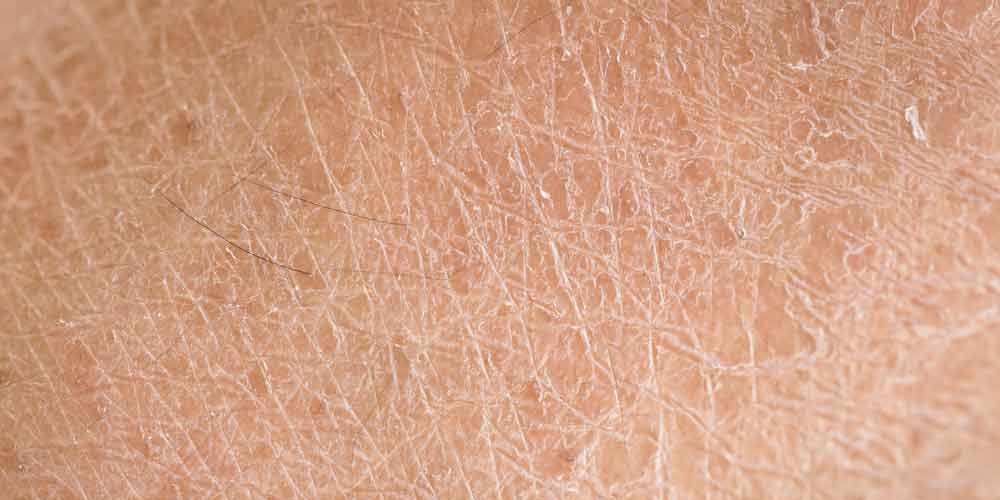 Многие люди замечают, что кожа на их теле начинает шелушиться, зудеть, возникают неприятные покраснения и очаги особой чувствительности Сухость кожи