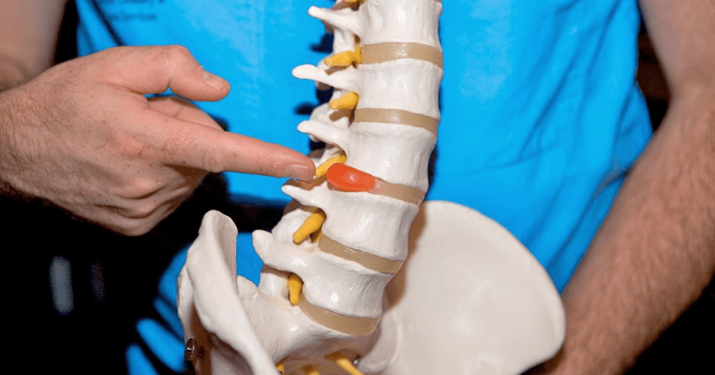 Грыжей позвоночника называется прогрессирующее заболевание, при котором деформируются межпозвоночные диски Грыжа позвоночника