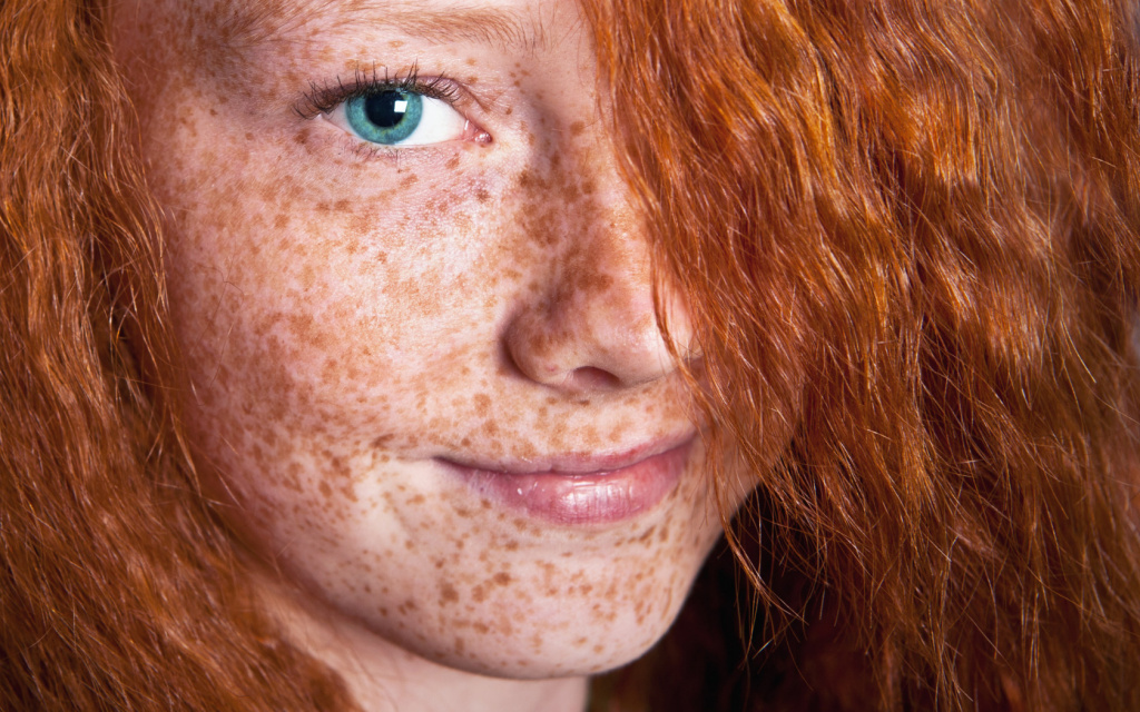 К пигментным пятнам обычно относятся веснушки или эфелиды Веснушки или эфелиды