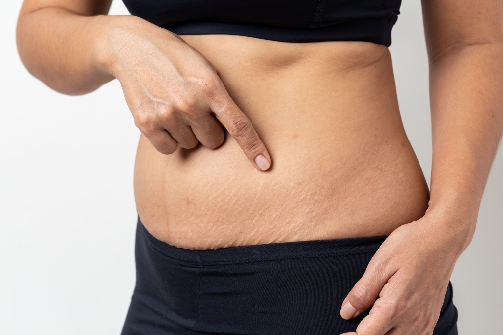 Растяжки (стрии) – это кожный дефект, в результате которого в некоторых местах на теле образуется рубцовая ткань Растяжки (стрии)