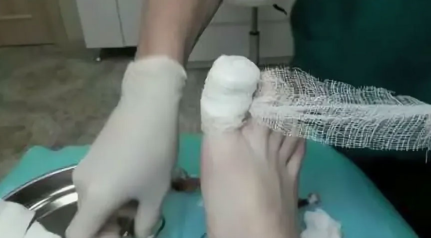 Хирургическое лечение вросшего ногтя в Хабаровске