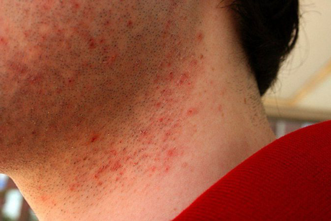 Раздражение на лице после бритья у мужчин: из-за чего возникает, как  устранить?