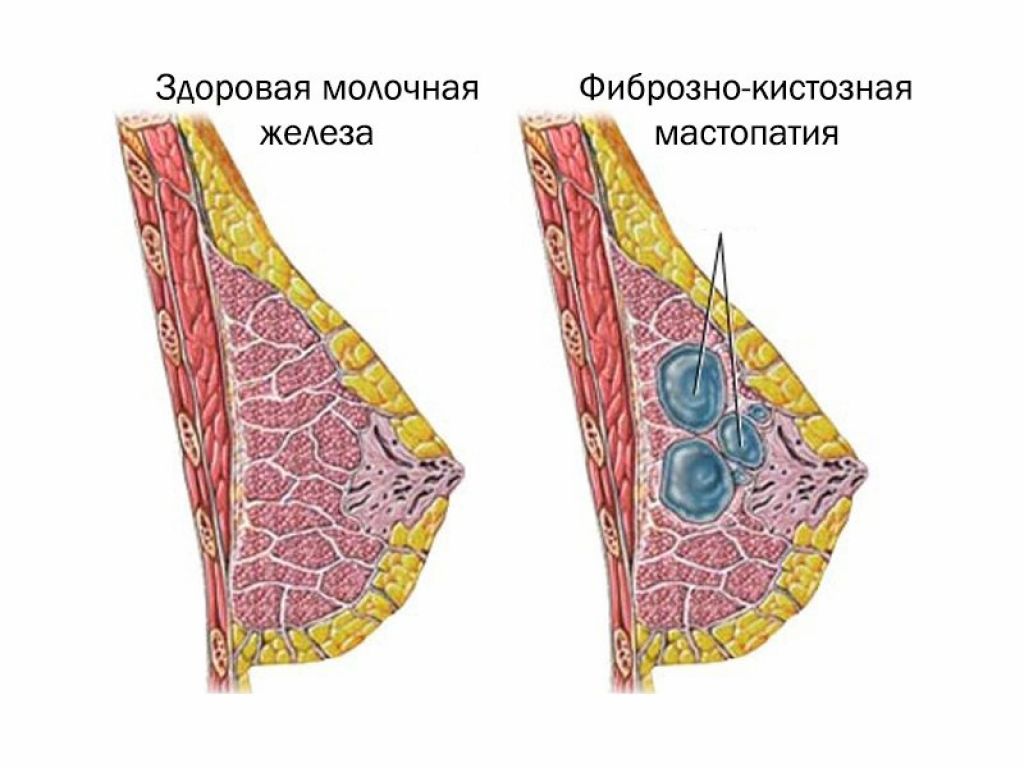 Что такое мастопатия молочных желез