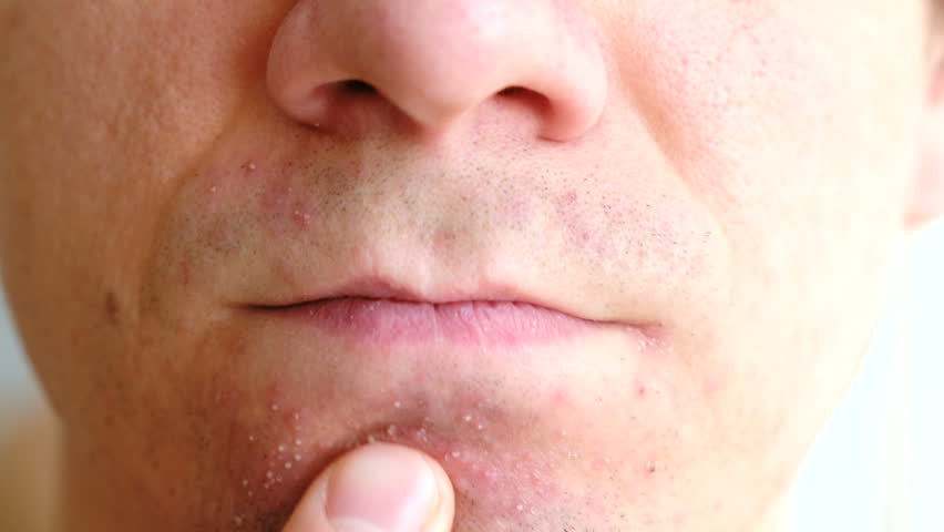 Что делать если на лице после бритья появляются прыщи