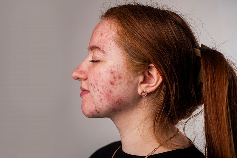 Что нельзя есть при акне