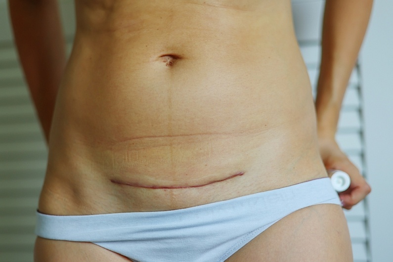 Когда можно заниматься спортом после кесарева сечения?