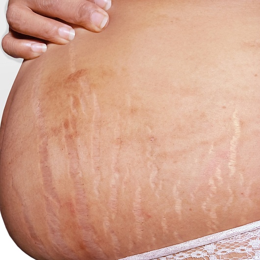 Избавление от белых растяжек