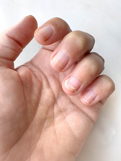 Как ухаживать за удаленным ногтем