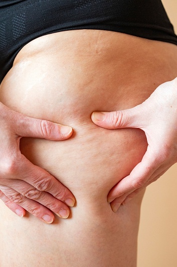 Причины образования целлюлита