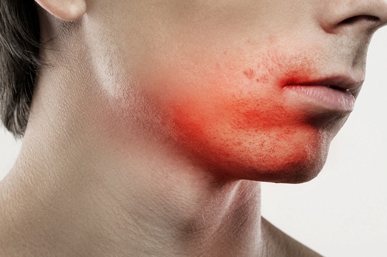 Прыщи после бритья - что делать?