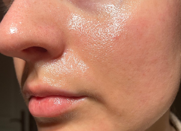 Уход за жирной кожей лица