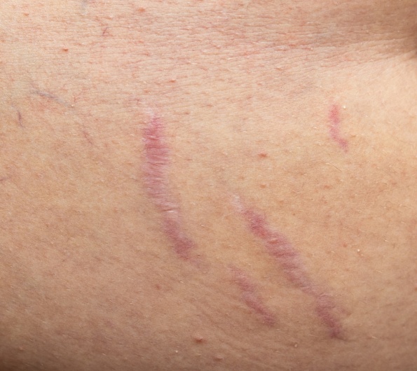 Избавление от красных растяжек