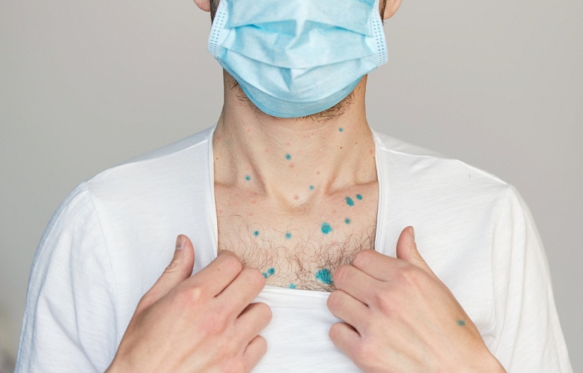 Зеленка от прыщей – помогает ли, можно ли мазать прыщи зеленкой