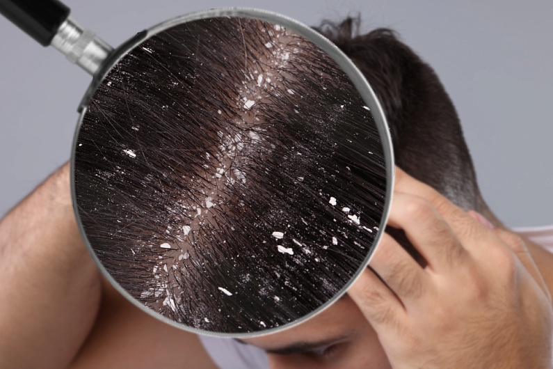 Как выглядит перхоть на волосах и коже головы?