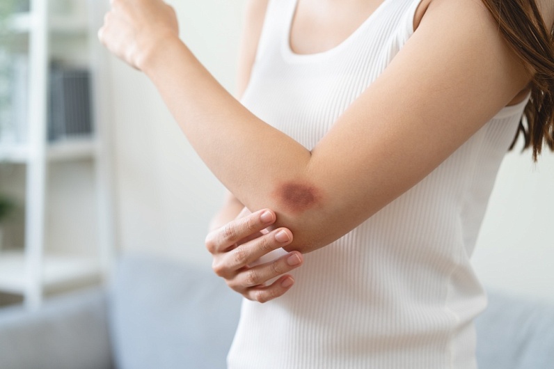 Как избавиться от синяка