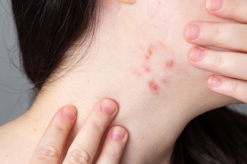 Акне на шее – причины, лечение, профилактика