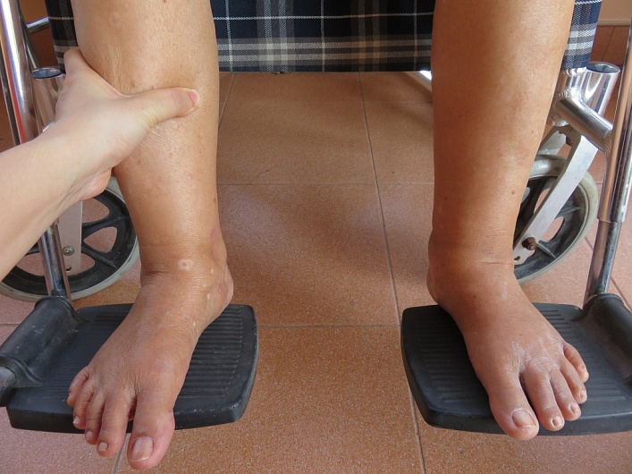 Задержка жидкости в организме: причины и способы лечения