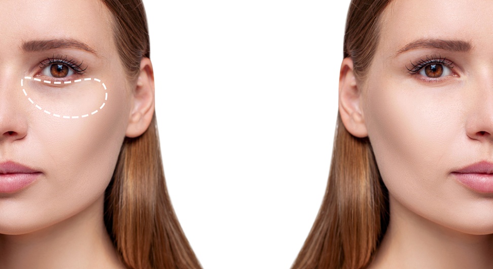 Причины мешков под глазами