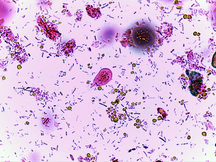 Лямблиоз: как вылечить лямблии