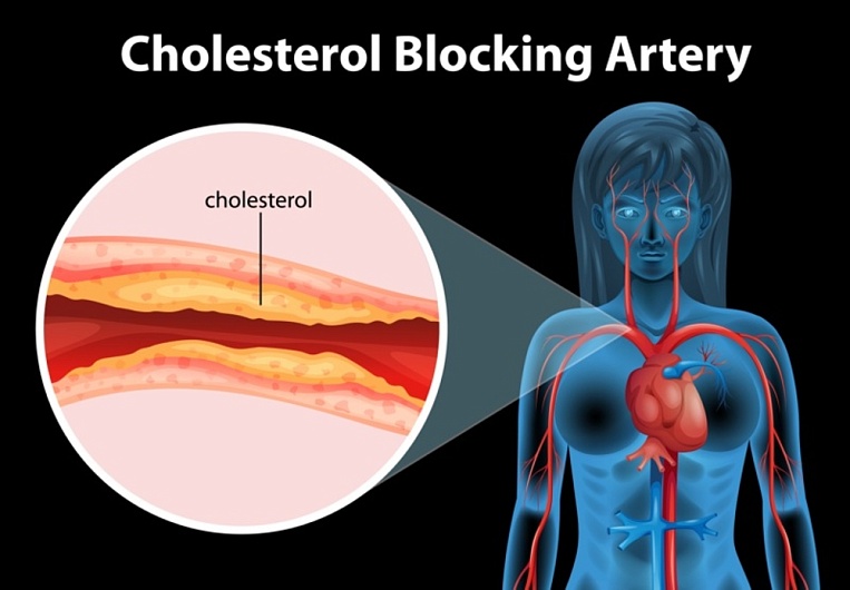 О чем говорит повышенный холестерин?